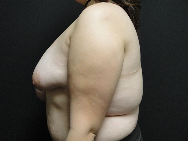 Breast Asymmetry Correction Before and After | Arizona Aesthetic Associates