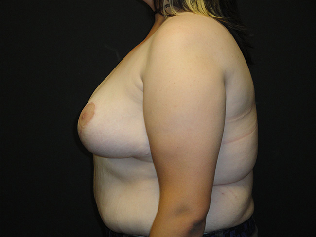 Breast Asymmetry Correction Before and After | Arizona Aesthetic Associates