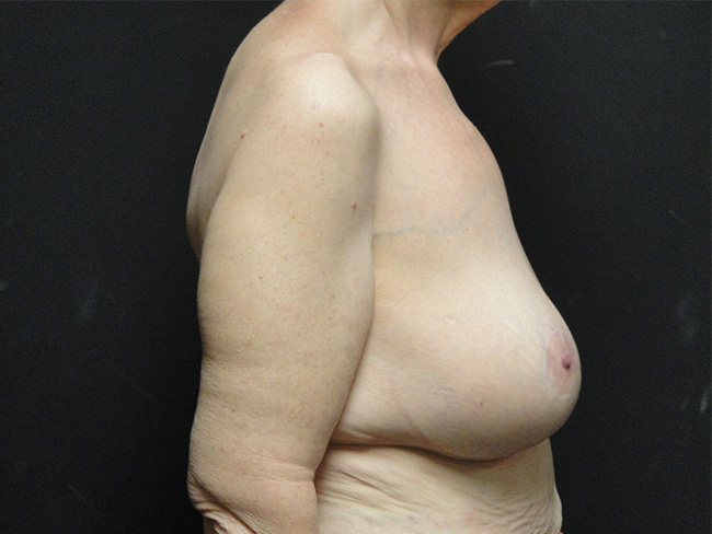 Breast Lift Before and After | Arizona Aesthetic Associates