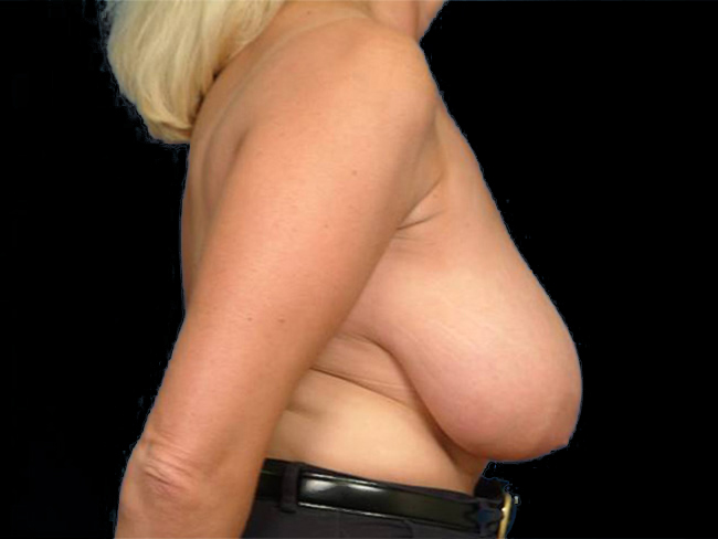 Breast Lift Before and After | Arizona Aesthetic Associates