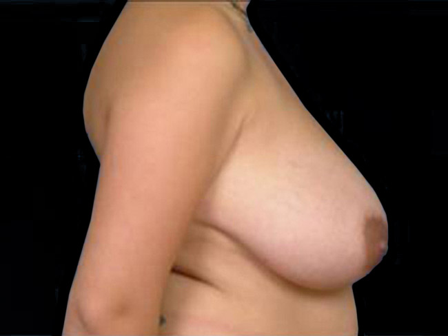 Breast Reduction Before and After | Arizona Aesthetic Associates
