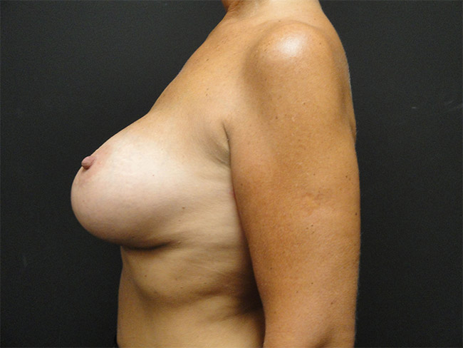 Breast Revision Before and After | Arizona Aesthetic Associates