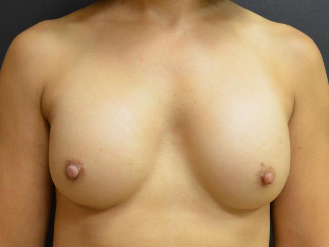 Breast Revision Before and After | Arizona Aesthetic Associates