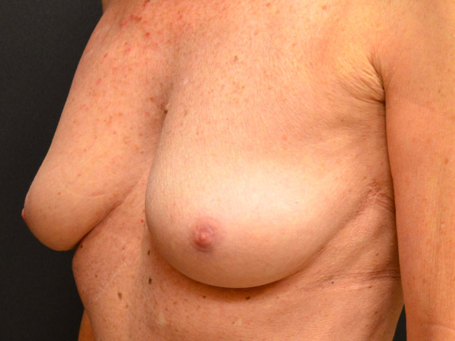 Nipple Correction Before and After | Arizona Aesthetic Associates