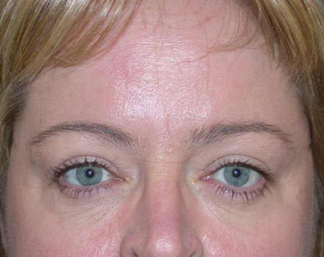 Eyelid Surgery Before and After | Arizona Aesthetic Associates