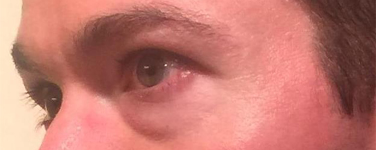 Eyelid Surgery Before and After | Arizona Aesthetic Associates