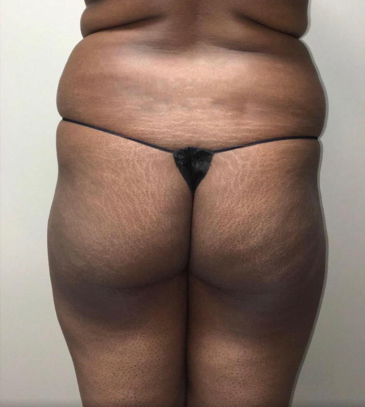 Brazilian Butt Lift Before and After | Arizona Aesthetic Associates