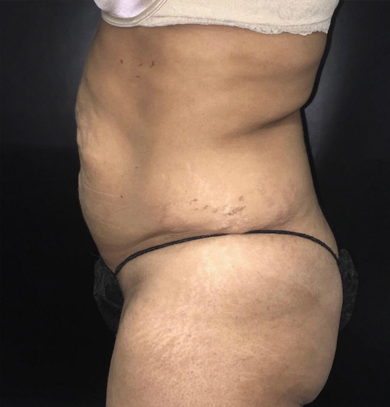 Tummy Tuck Before and After | Arizona Aesthetic Associates