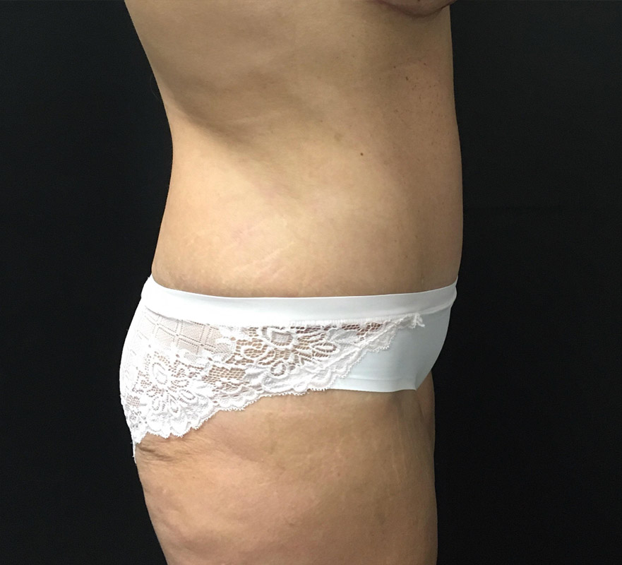 Tummy Tuck Before and After | Arizona Aesthetic Associates