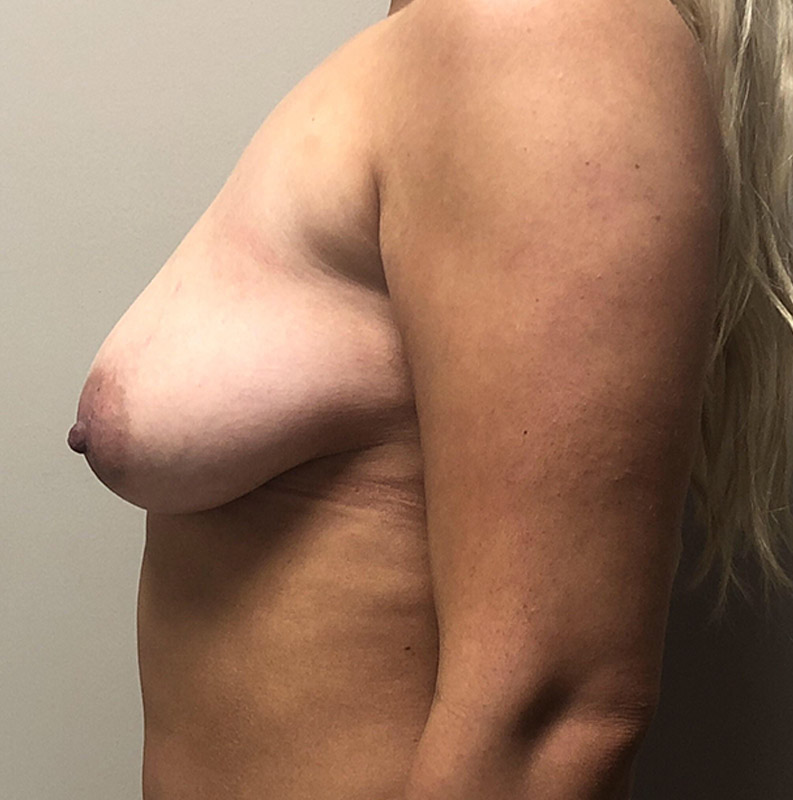 Breast Augmentation Lift Before and After | Arizona Aesthetic Associates