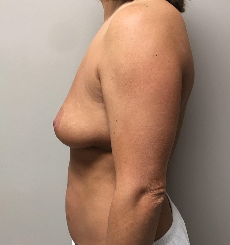 Breast Augmentation Lift Before and After | Arizona Aesthetic Associates