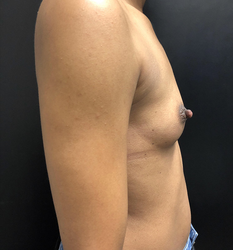 Breast Augmentation Before and After | Arizona Aesthetic Associates
