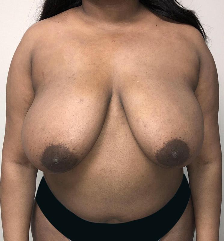 Breast Reduction Before and After | Arizona Aesthetic Associates