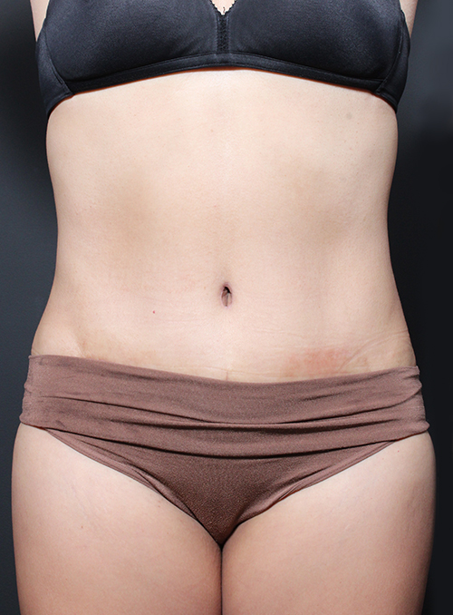 Abdominoplasty Before and After | Arizona Aesthetic Associates