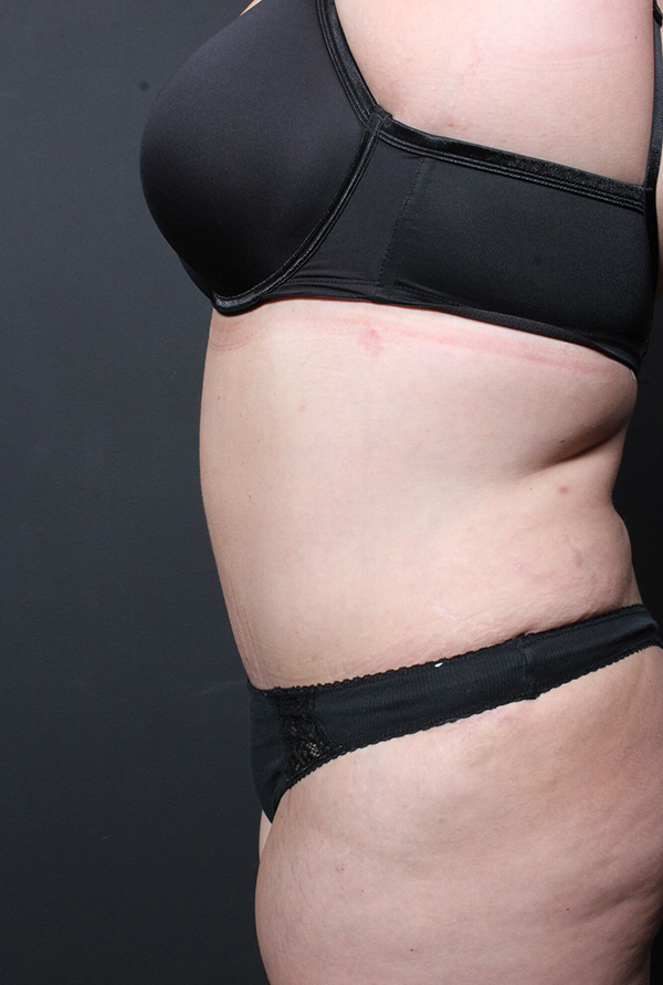 Abdominoplasty Before and After | Arizona Aesthetic Associates