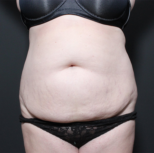 Liposuction Before and After | Arizona Aesthetic Associates