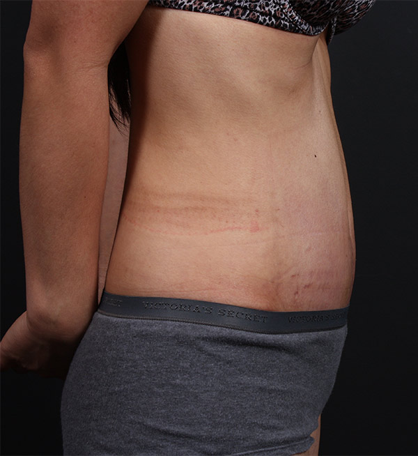 Liposuction Before and After | Arizona Aesthetic Associates