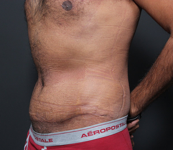 Male Tummy Tuck Before and After | Arizona Aesthetic Associates