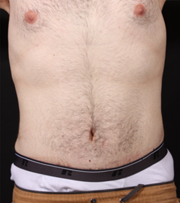 Male Tummy Tuck Before and After | Arizona Aesthetic Associates