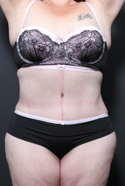 Plus Size Tummy Tuck Before and After | Arizona Aesthetic Associates