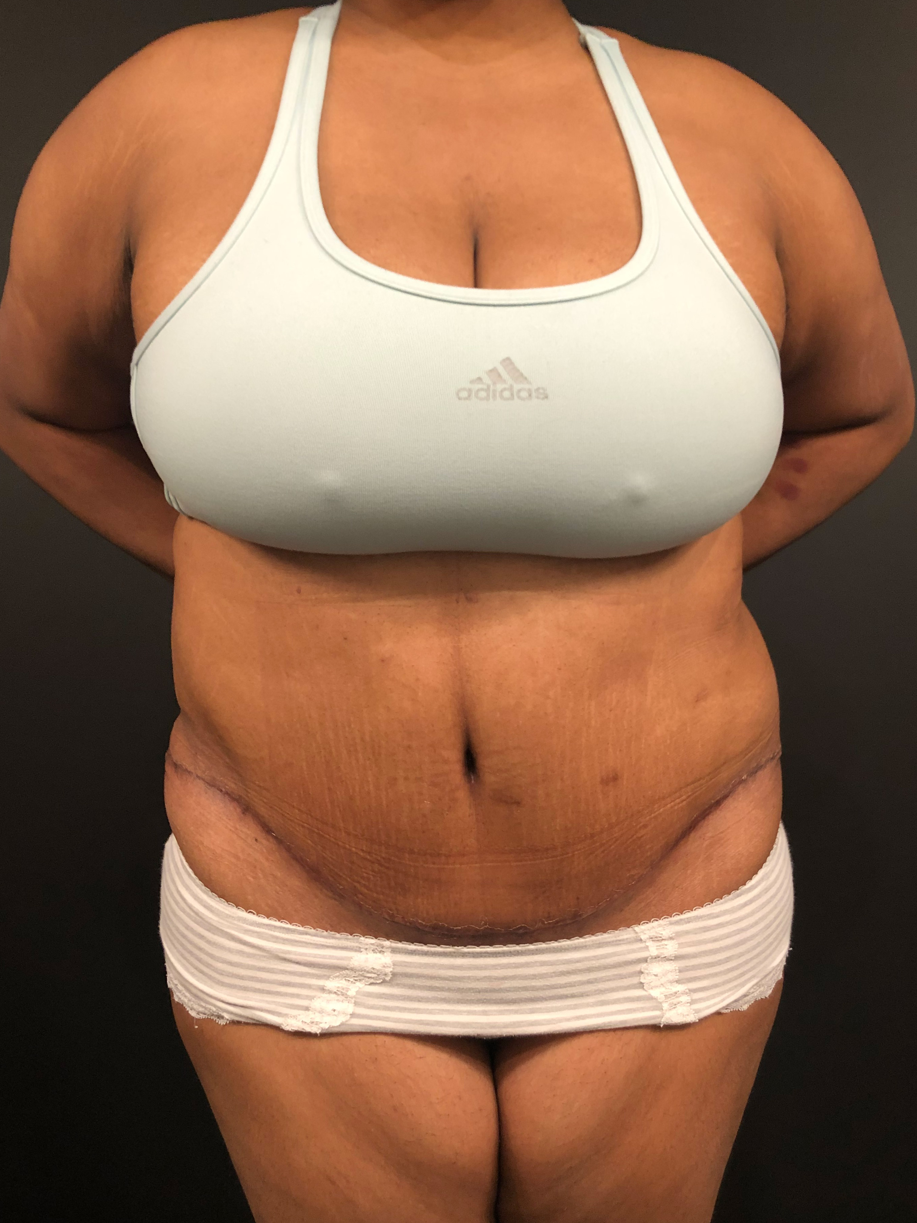Plus Size Tummy Tuck Before and After | Arizona Aesthetic Associates