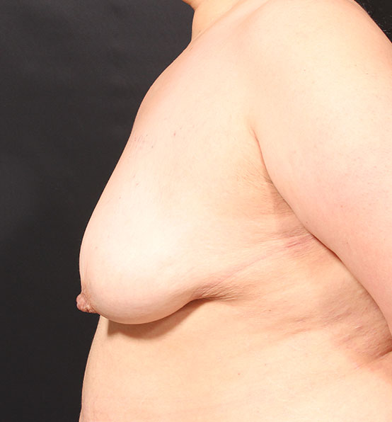 Breast Aug Fat Grafting Before and After | Arizona Aesthetic Associates