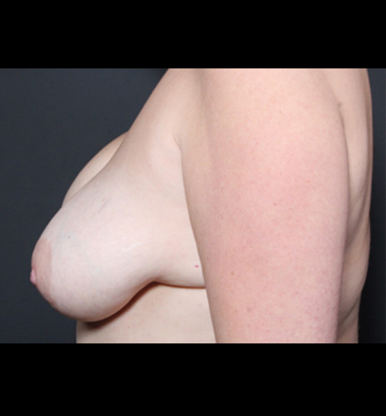 Breast Implant Revision Before and After | Arizona Aesthetic Associates