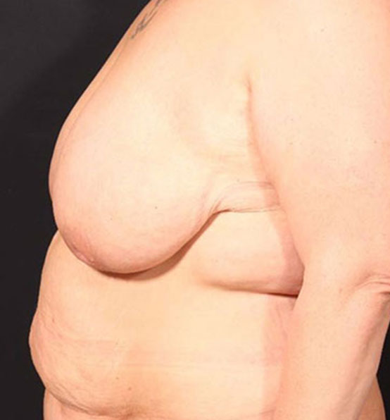 Breast Lift Mastopexy Before and After | Arizona Aesthetic Associates