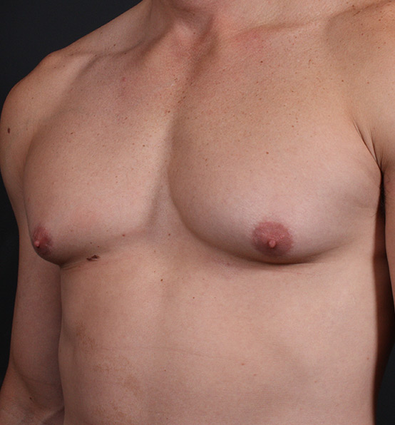 Male Chest Reduction Before and After | Arizona Aesthetic Associates