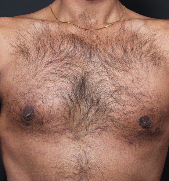 Male Chest Reduction Before and After | Arizona Aesthetic Associates