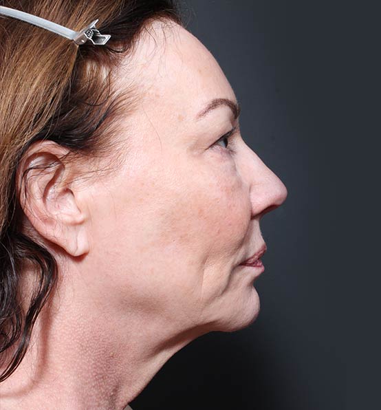 Neck Lift Before and After | Arizona Aesthetic Associates