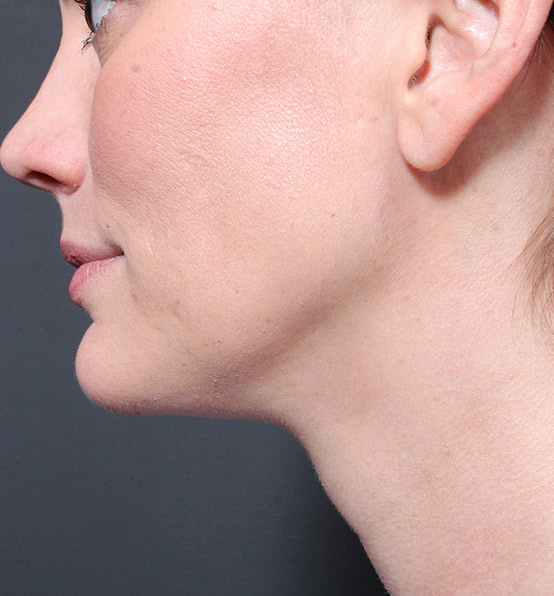 Neck Liposuction Before and After | Arizona Aesthetic Associates