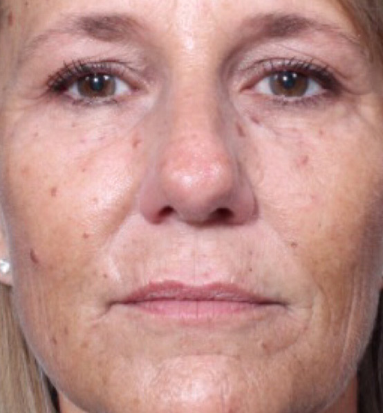 Injectables Before and After | Arizona Aesthetic Associates