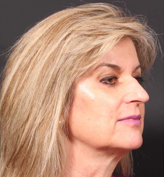 Injectables Before and After | Arizona Aesthetic Associates