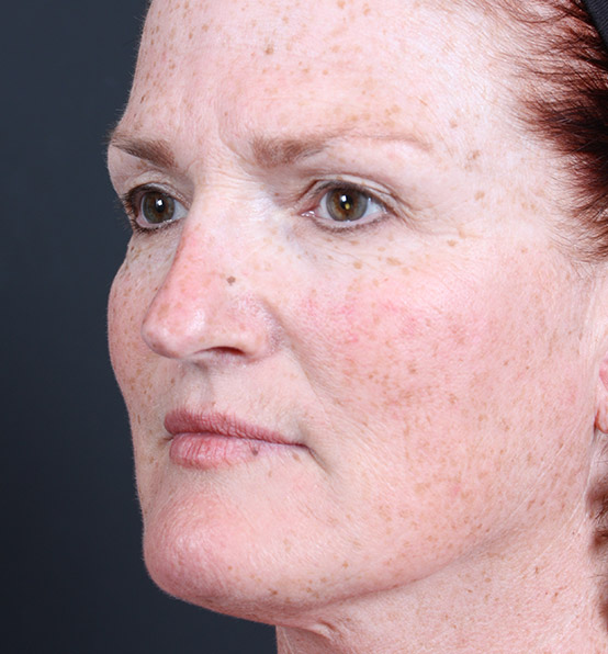 Skin Resurfacing Before and After | Arizona Aesthetic Associates