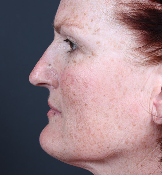 Skin Resurfacing Before and After | Arizona Aesthetic Associates