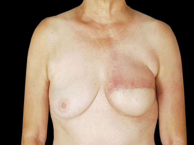 Breast Flap Reconstruction Before and After | Arizona Aesthetic Associates