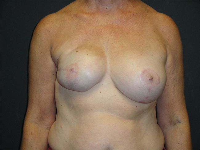 Breast Flap Reconstruction Before and After | Arizona Aesthetic Associates
