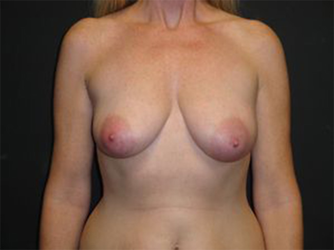 Breast Implant Reconstruction Before and After | Arizona Aesthetic Associates