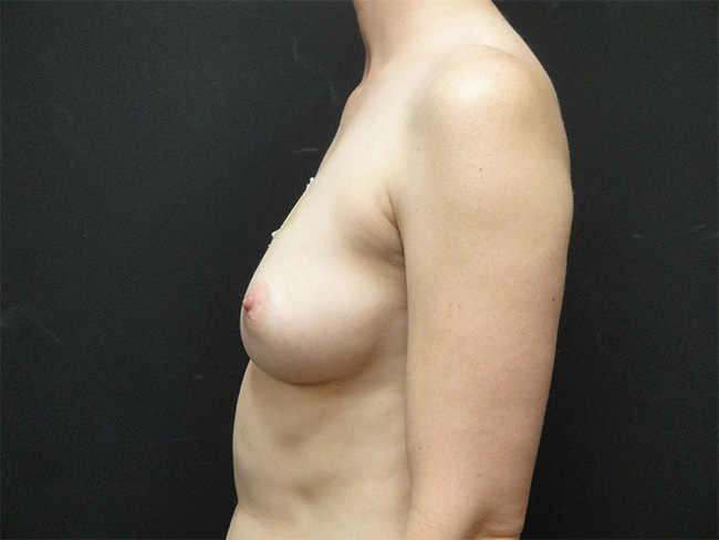 Breast Implant Reconstruction Before and After | Arizona Aesthetic Associates